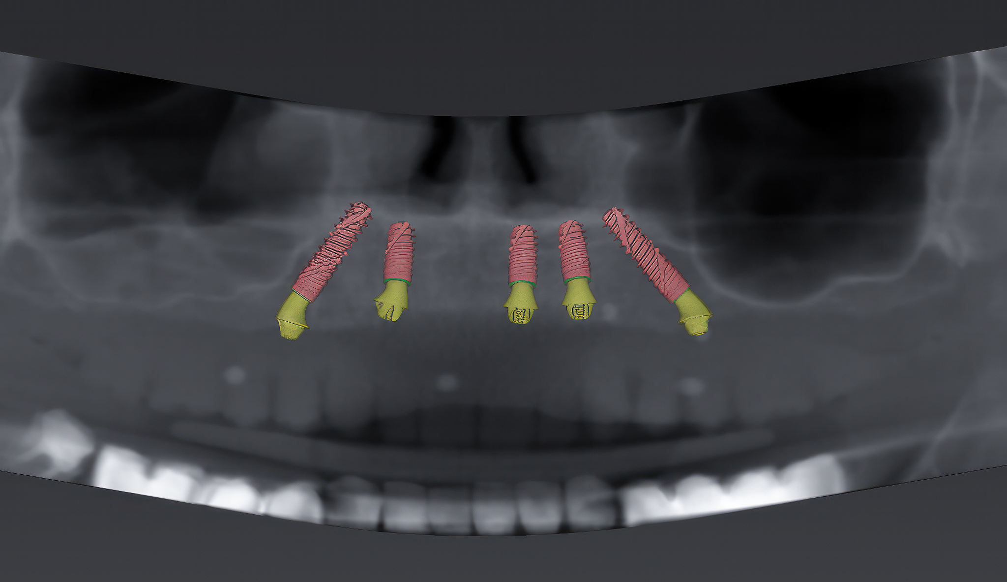 Symulacja określająca lokalizację implantów w jamie ustnej pacjenta