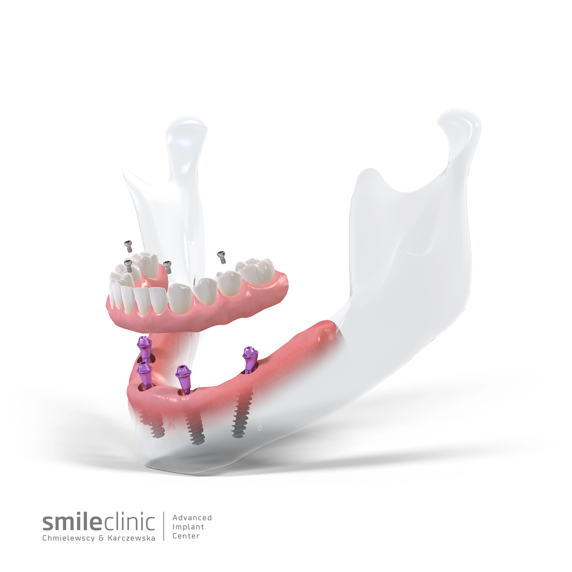 Ilustracja prezentuje elementy leczenia Allon4 w żuchwie. Widoczne są 4 implanty, 4 łączniki (elementy fioletowe) oraz most wraz ze śrubkami do jego przykręcenia.